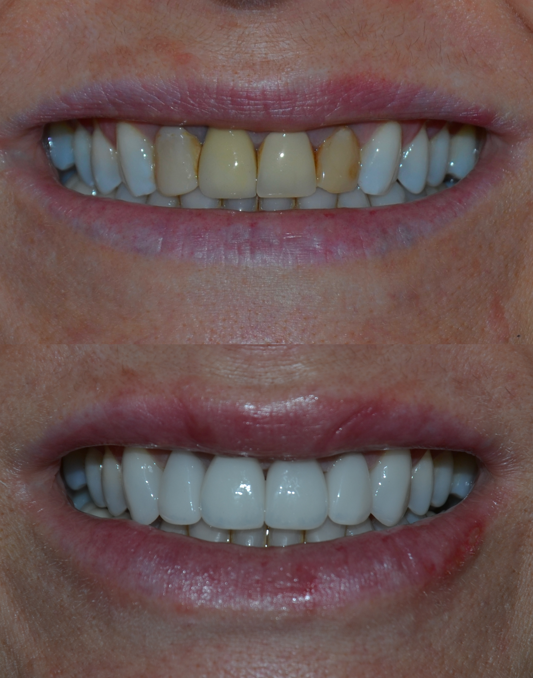 Lentes de Contato Dental